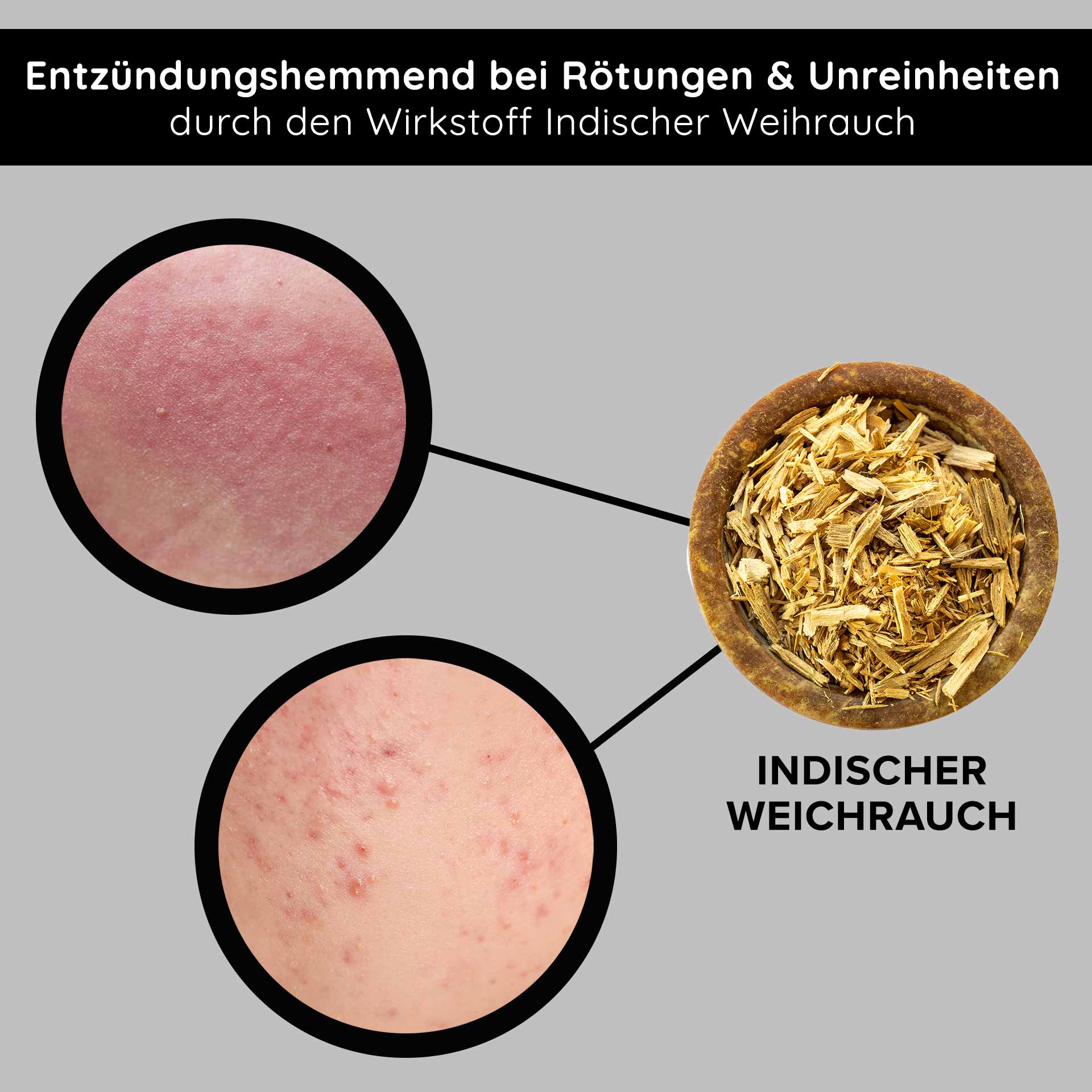 Tri-Peeling 50 мл Пилинг с энзимами и фруктовыми кислотами Entzündungshemmendes Indischer Weihrauch zur Reduzierung von Rötungen und Unreinheiten, mit Nahaufnahmen von betroffener Haut.